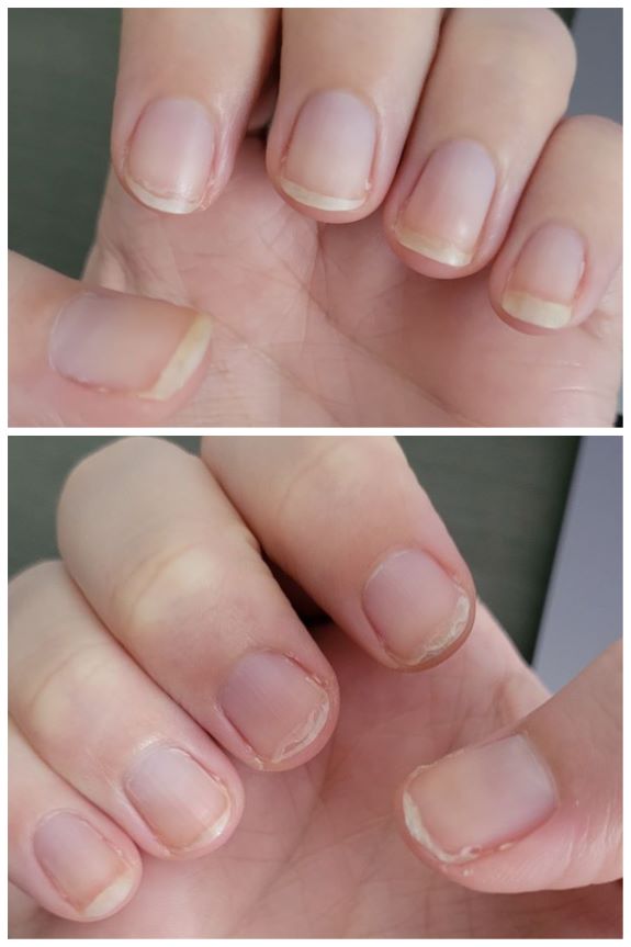Photos of left and right hands with slight improved, but mostly still sad looking nails.