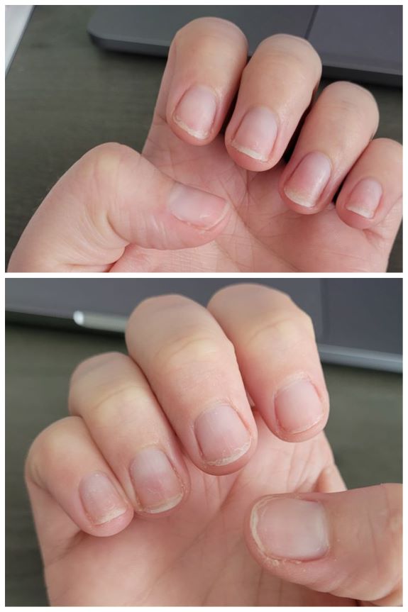 Photos of right and left hands, with very sad looking nails